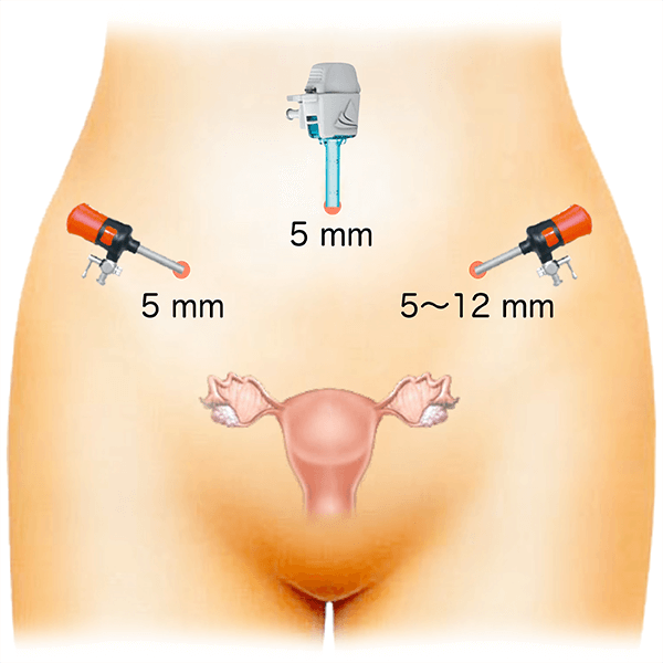 laparoscopy